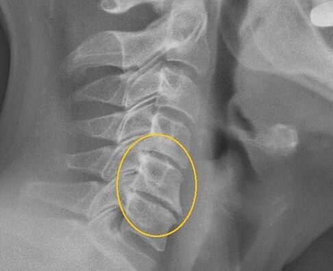 osteochondrosis ของกระดูกสันหลังส่วนคอบน x -ray