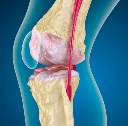 arthrososis ของข้อเข่า